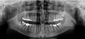 Panorama røntgenbilde brukt for å diagnostisere sykdom i munnhulen, viser fullstendig oversikt over tennene og kjevebenet