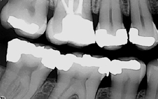Dental røntgenbilder som viser en detaljert oversikt over en pasients tenner med fyllinger, brukt for diagnostisk vurdering i tannbehandling
